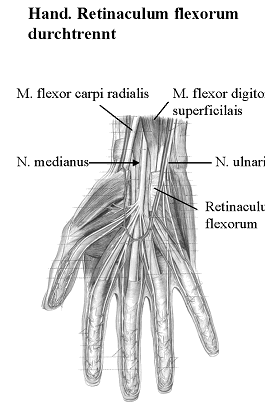 Hand. Retinaculum flexorum durchtrennt